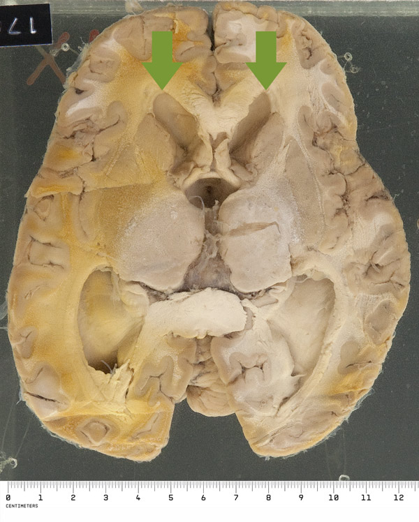 The reverse of the specimen shows striking symmetrical ventricular dilatation (as shown by rounding of the normally acute anterior horns near the top of the picture) 