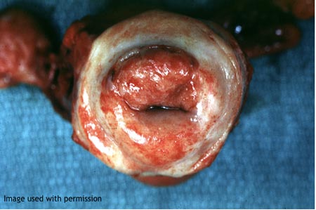 Early invasive cervical squamous carcinoma