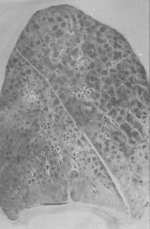 Thin section of whole left lung showing gross changes of emphysema viz. overexpanded airspaces (dark pockets), most prominent in the uper lobe.