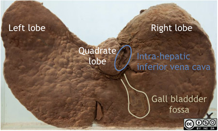 Pathology of cirrhosis liver