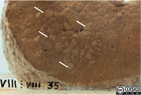 nodules