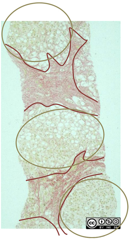 liver biopsy