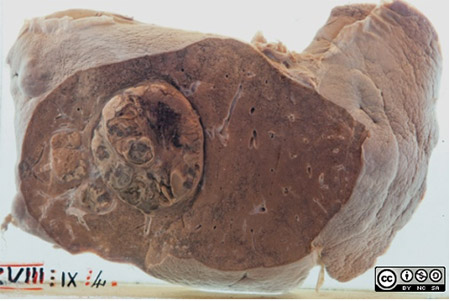 liver specimen