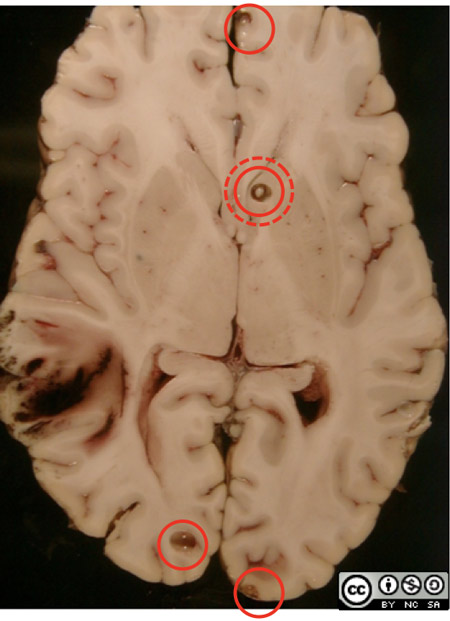 Also seen in the specimen are several scattered cysts about 0.5cm in diameter.