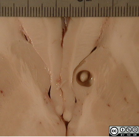 In this enlargement of the cysticercus cyst one can see the protoscolex protruding into the cyst cavity.