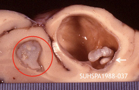 granulomatous inflammatory reaction