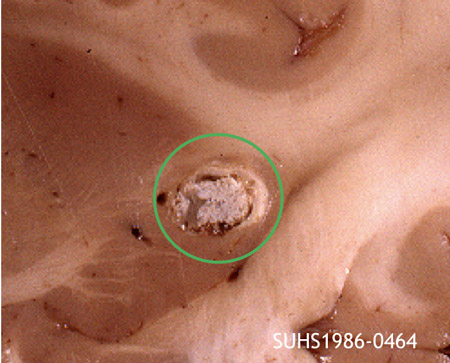 cystic granuloma