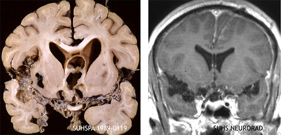 cysticercus granulomatous meningitis