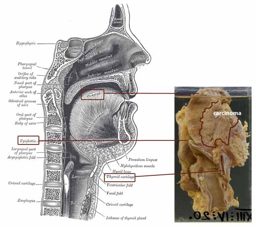 Diagram and specimen photo: squamous cell carcinoma of the floor of the mouth