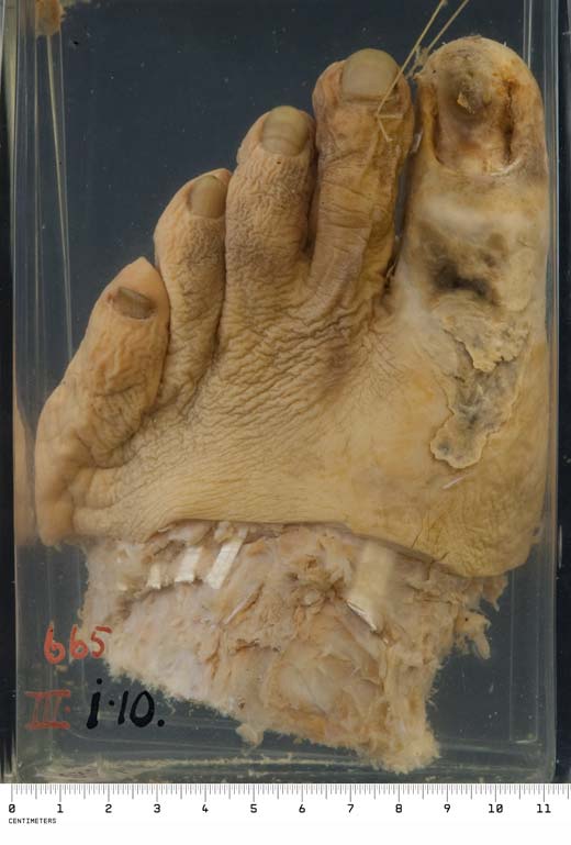 Photograph: Gangrene of the foot