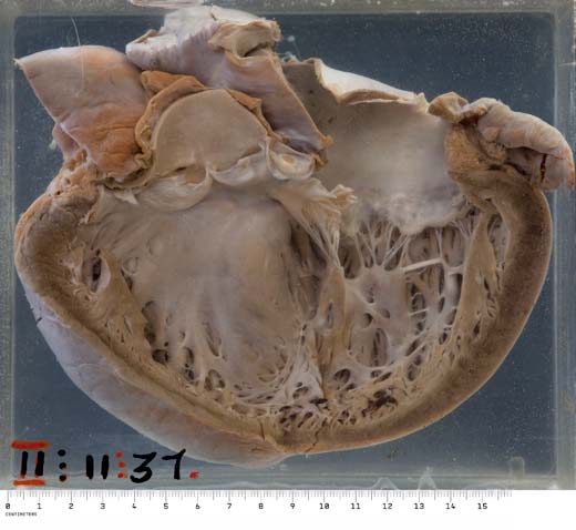 Dilated cardiomyopathy