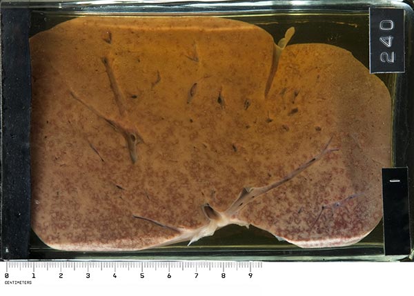 The liver removed at autopsy shows features pathognomonic of herpes. Against the pale yellow background of a very fatty liver are innumerable circular white spots surrounded by a narrow well-defined rim of intense congestion. The lesions vary in size