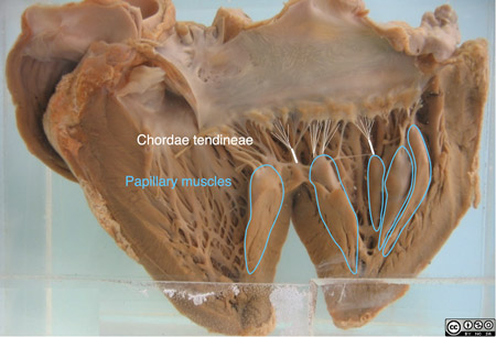 Note in particular the normal delicate chordae tendineae and the papillary muscles.