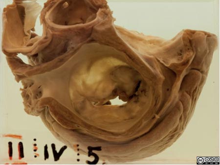 Mitral stenosis