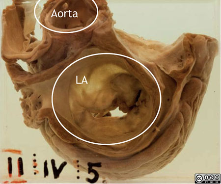 A cross-section of the left side of the heart, viewing the left atrium from above.