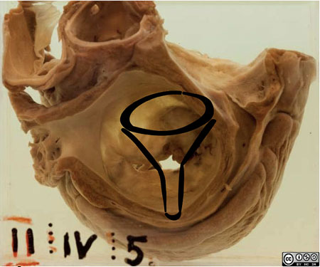 Funnel stenosis