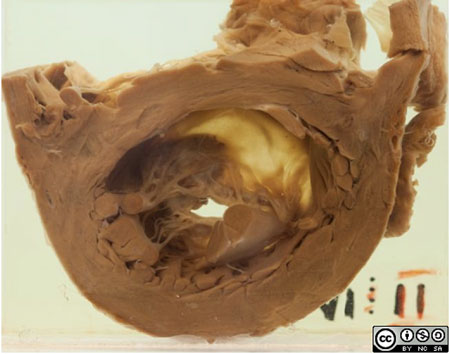 Here is the transected left ventricle, viewing the abnormal mitral valve from below.