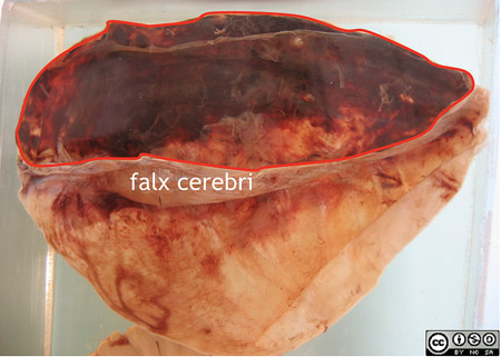 This part of the specimen is the dura of the fronto-parietal region which has been stripped from the upper half of the skull.