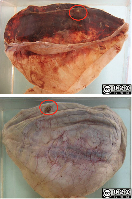 A sealed burr hole opening can be seen on the right hand edge of the dura.