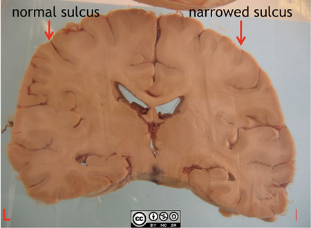 This coronal slice from the same patient shows swelling of the right hemisphere, with slight compression of the right lateral ventricle. 