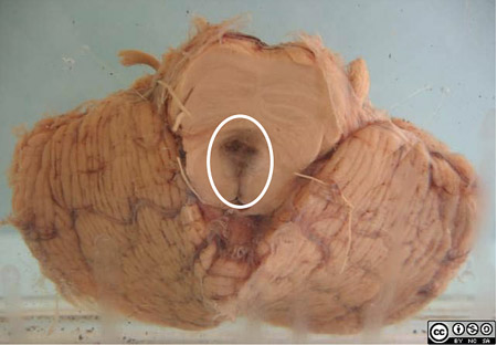 There is a midline midbrain haemorrhage, a consequence of raised intracranial pressure and caudal shift of the midbrain, with overstretching of the perforating branches of the basilar artery.