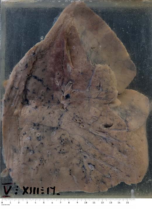 Lipid pneumonia lung specimen from the Pathology Learning Centre, Cape Town, South Africa