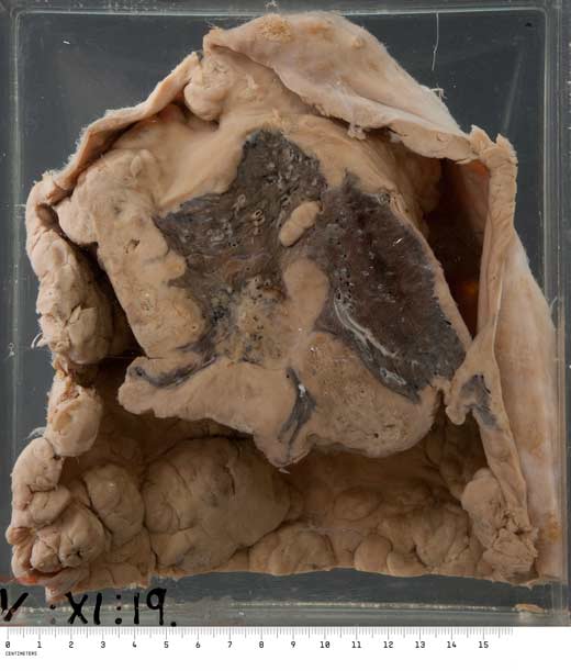 Pleural mesothelioma