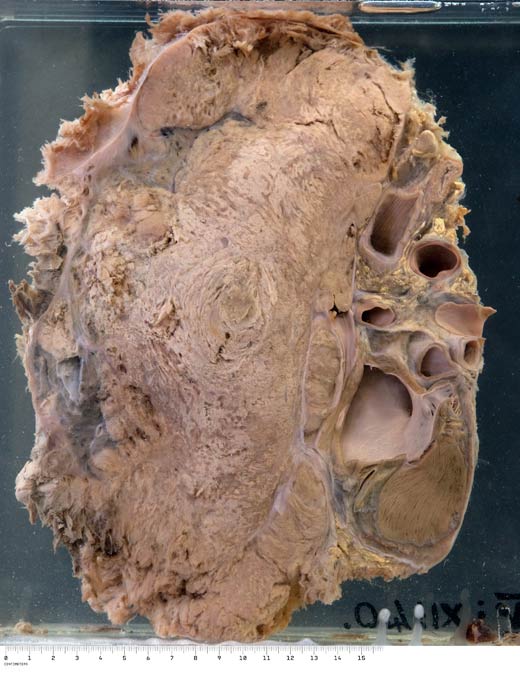 Pleural mesothelioma