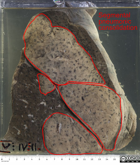 Left lung which has been partially sectioned to show the grey-white areas of pneumonic consolidation. 