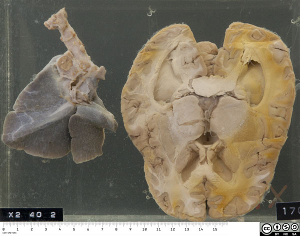 The specimen comprises the right lung and the inferior half of the brain