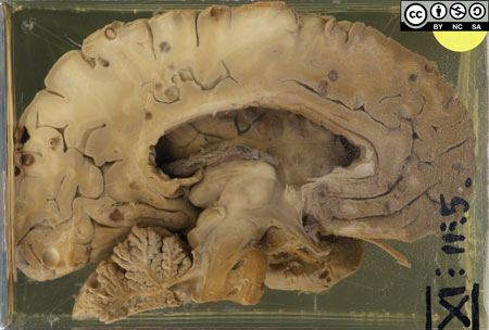 heavy infestation of cysticerci