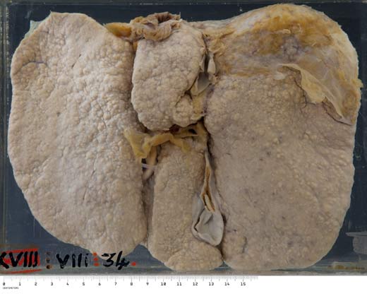 Cirrhosis of the liver