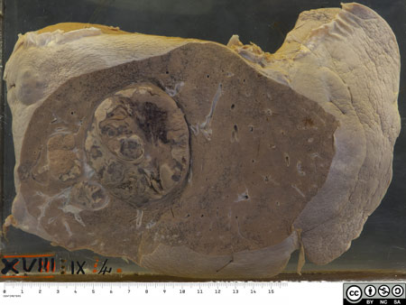 Hepatocellular carcinoma 