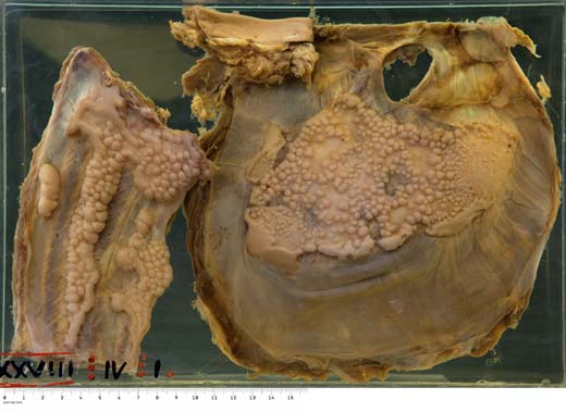 Fibrous plaques on diaphragm