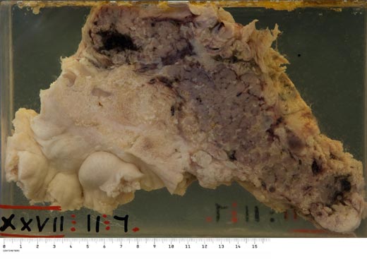 Acute haemorrhagic pancreatitis