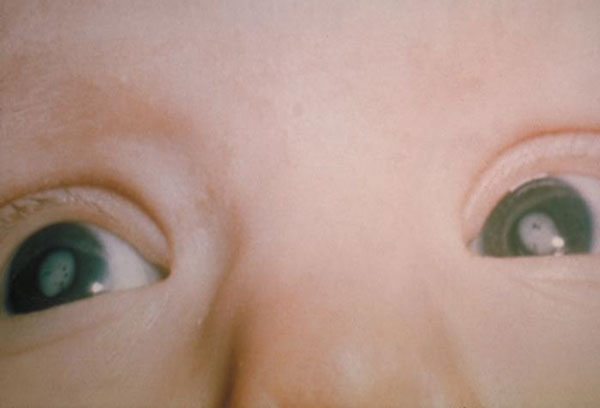 Cataracts - photograph, credit CDC