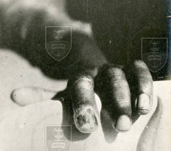 The high rate of venereal and congentital syphilis was a hazard for midwives. This chancre on the finger,  was the result of an accidental infection of a midwife - year unknown.