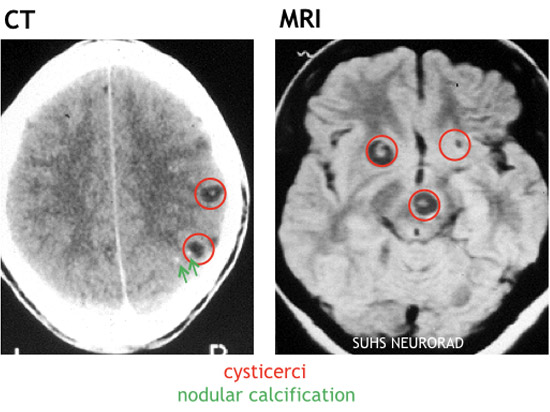 ct and mri of cyticerci