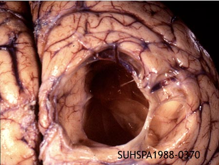 cyticercosis