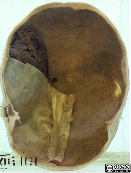 Epidural haematoma skull photo