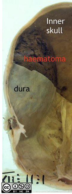 Note the location of the haematoma, it lies between the dura and the internal surface of the skull  i.e. it is epidural or extradural. 