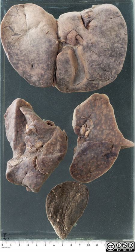 The liver, lungs and spleen from a 3 month old child who died of extensive miliary tuberculosis.