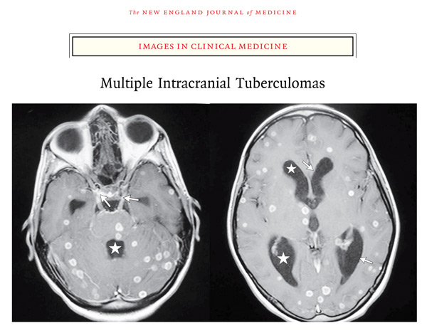 Akhadder A & Boucetta M. Images in Clinical Medicine: Multiple Intracranial Tuberculomas. N Engl J Med 2011; 365:1527, image and link	