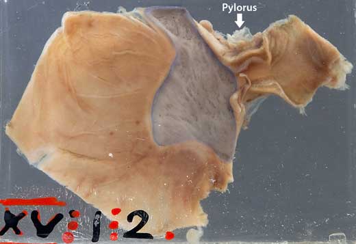 Pathology macro photograph: Congenital hypertrophic pyloric stenosis