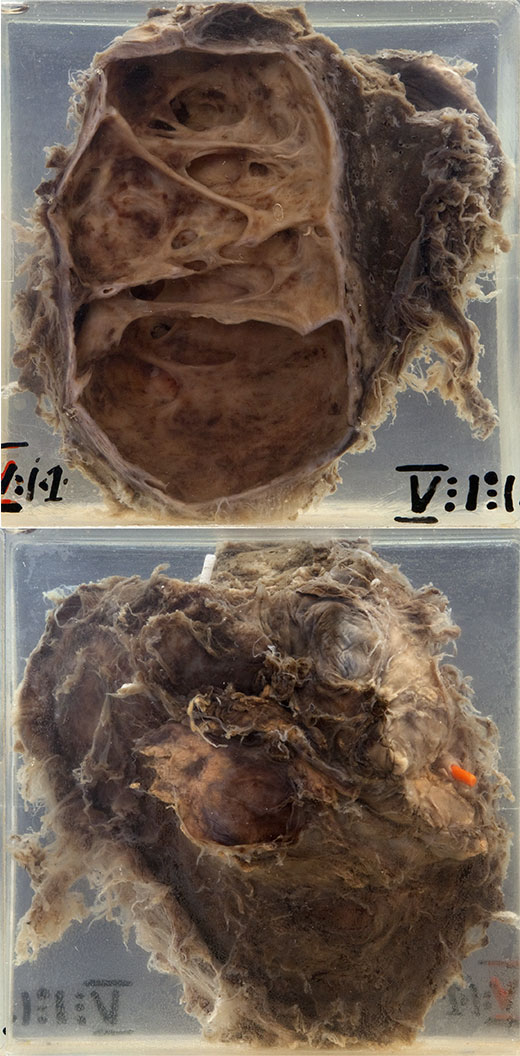 In the mounted specimen one sees a lobe of lung with dense pleural adhesions.