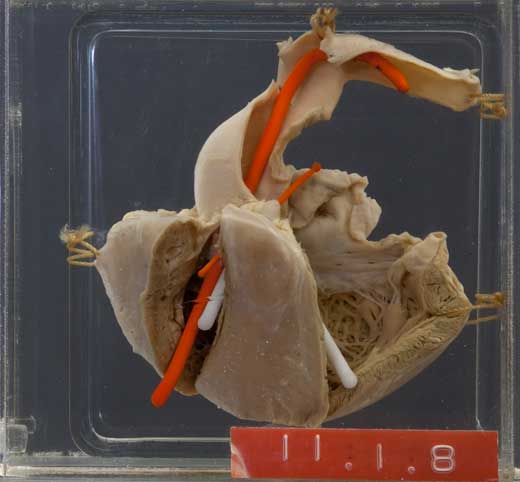 This pathology specimen photograph shows the four components of the tetralogy of Fallot