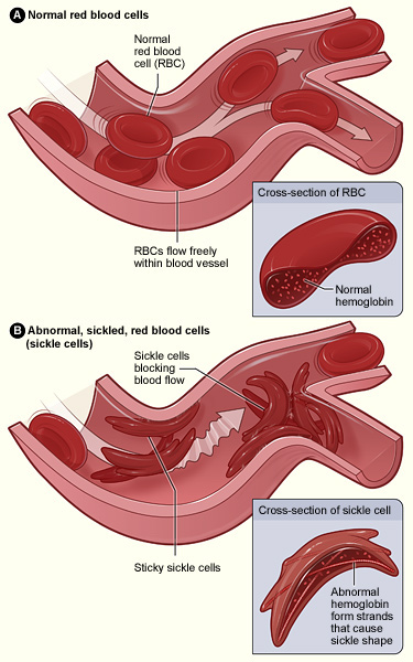 Normal blood cells versus sickle cells