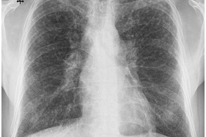 sarcoidosis-tb