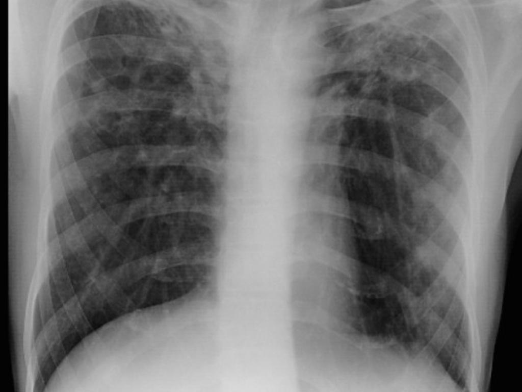 S100A8/A9 regulates CD11b expression and neutrophil recruitment during chronic tuberculosis"