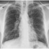 sarcoidosis-tb